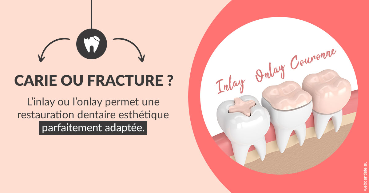 https://dr-nicolas-cecile.chirurgiens-dentistes.fr/T2 2023 - Carie ou fracture 2