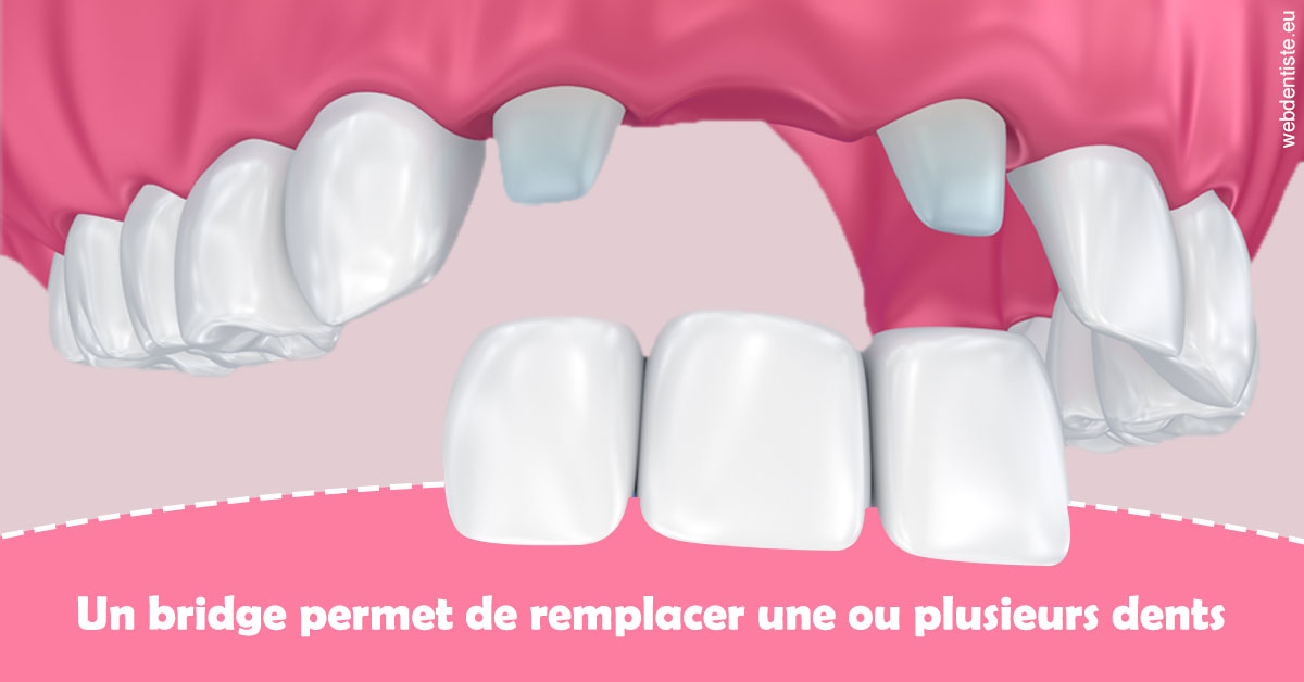 https://dr-nicolas-cecile.chirurgiens-dentistes.fr/Bridge remplacer dents 2