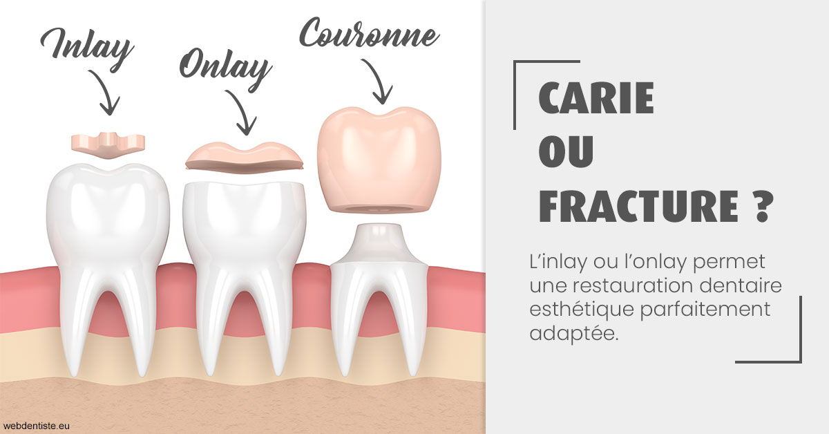 https://dr-nicolas-cecile.chirurgiens-dentistes.fr/T2 2023 - Carie ou fracture 1
