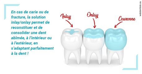 https://dr-nicolas-cecile.chirurgiens-dentistes.fr/L'INLAY ou l'ONLAY